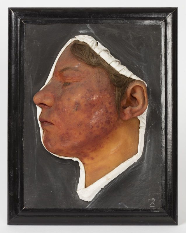 Cire anatomique : profil d’une femme atteinte de tubercules syphilitiques